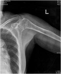 posterioraspectsofproximalforearm anddorsum ofhand.