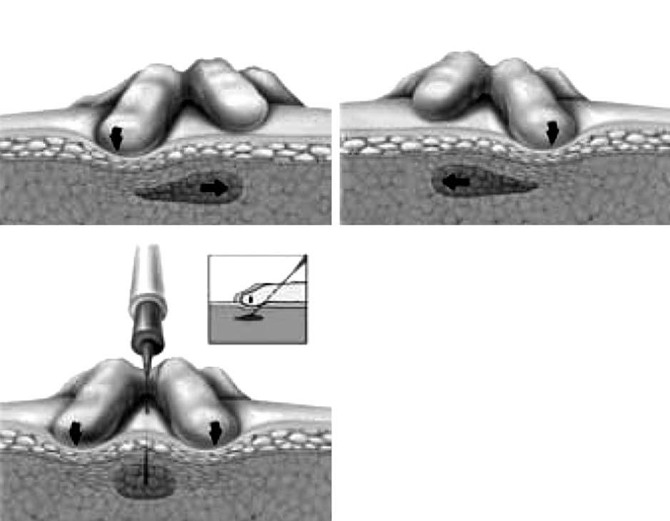 6 / 김영호 김이석 A B C Fig. 3. Cross-sectional schematic drawing of flat palpation to localize and hold the trigger point (dark red spot) for injection.