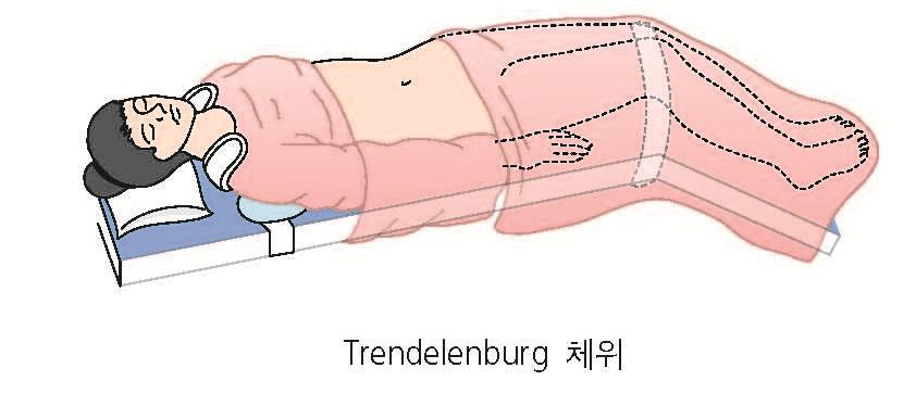 3. 수술중처치 수술체위 트렌델렌버그 trendelenburg position 하복부수술, 골반수술 머리를낮춘체위