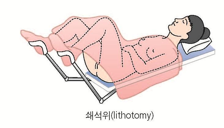 3. 수술중처치 수술체위 쇄석위 lithotomy position