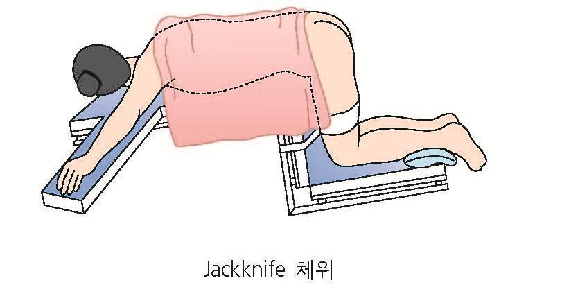 3. 수술중처치 수술체위 잭나이프 jackknife position