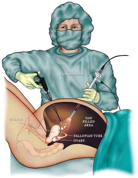 3. 수술중처치 다양한수술법 내시경수술 신체개구부를통하거나피부를약간절개한후 내시경을삽입하여직접보거나