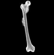 ᄃ진단 a 조기 ; bone scan(