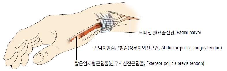 6. 협착성힘줄윤활막염 (Stenosing tenosynovitis) ; = 드퀘르벵병 1) 원인손목관절을과도하게사용하는경우, 만성적협착성힘줄윤활막염, 손목통증 <anatomic snuff box> (1) radial border 1 Abduction