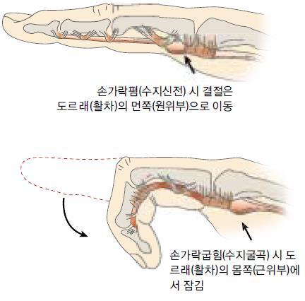 7. 방아쇠손가락 (Trigger fingers) 1) 원인 - 손가락의굽힘근힘줄 ( 앝은손가락굽힘근, 깊은손가락굽힘근 ) 에방추상결절 -