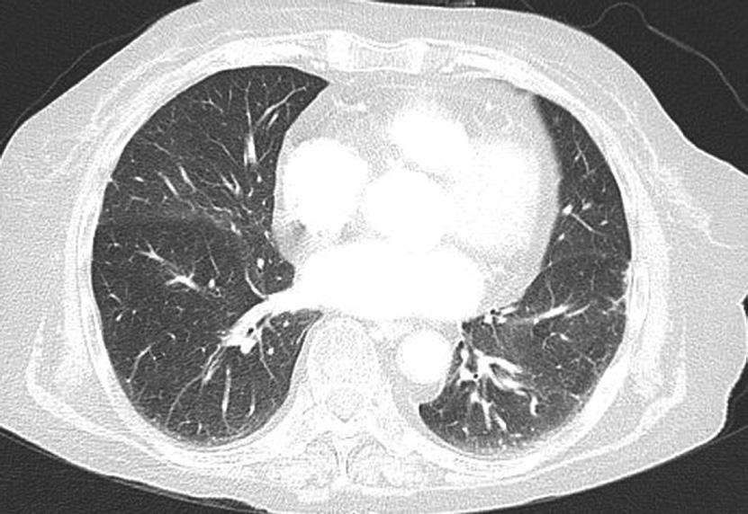 and low perfusion defect score (42.5/100).