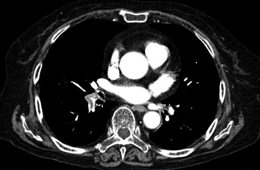 5/100) but relatively high perfusion defect score (60/100).