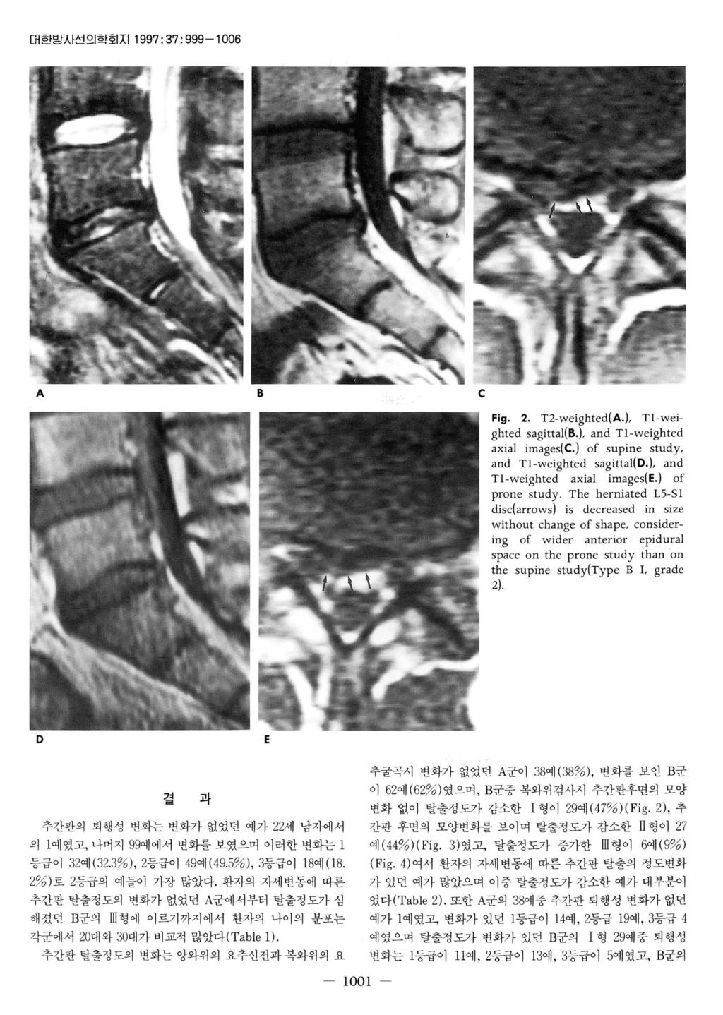 [H 한발시선의학호 지 1997 ; 37: 999-1 006 A B c Fig. 2. T2-weighted(A.), Tl-wei ghted sagittal(b.), and Tl-weighted axial images(c.) of supine study, and Tl-weighted sagittal(d.