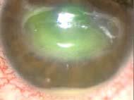 1. 희귀질환 신경영양성각막염 (NK) 각막의상피손상 (Corneal epithelial breakdown), healing 장애, 각막궤양, melting, 천공발생