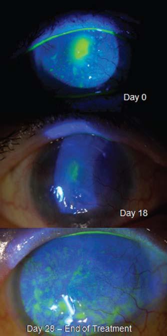 2. NK 치료제연구자임상결과 6 NK patients with corneal ulcers that had not healed for 6 weeks to several years either completely healed