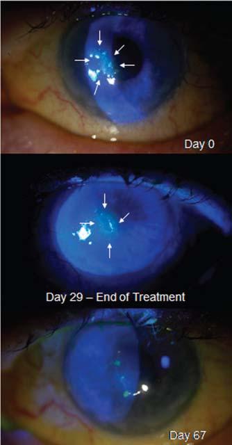 treatment initiation Tβ4 (RGN-259) shows promise in the management of chronic non-healing neurotrophic ulcers and appears to