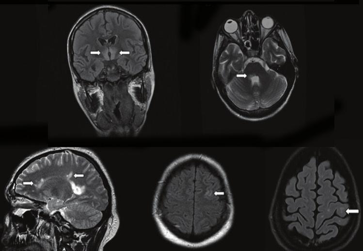 THE WINDOW OF MULTIPLE SCLEROSIS 배경 시신경척수염은오래전부터다발성경화증의변형으로알려져왔으나시신경척수염특이항체인 aquaporin-4(aqp4) 가발견되면서명확히다발성경화증과감별하게되었다. 시신경염과척수염이모두있으면서항체가양성인시신경척수염과척수염또는시신경염, 드물게뇌줄기 / 뇌병변만있으면서항체가양성인시신경척수염범주질환도있다.