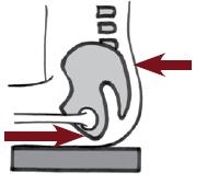문제 : 골반후방경사및전방미끄러짐 필요한지지 골반후방경사에서좀더중립적인앉은자세를취하기위해선대부분두부분에 지지가필요하다. 골반의뒤쪽후상장골극높이에서의지지 골반의앞쪽좌골 ( 좌골조면 ) 높이에서지지 자세보조용구 (PSD) 해결책 전좌골턱은좌골앞에지지를제공하고다음과같은도움을줍니다.