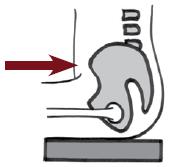 국소적고관절지지 (Supporting the Hips) 문제 : 중립적인앉은자세 (neutral sitting posture) 를하기위해한쪽고관절을구부릴수없다 ( 체간과허벅지사이각이 90 도이상 ) 이문제의임시해결책은양쪽좌골과중립적으로앉은자세 (neutral sitting posture) 를하기위해구부릴수있는고관절의허벅지아래에추가지지물 ( 폼