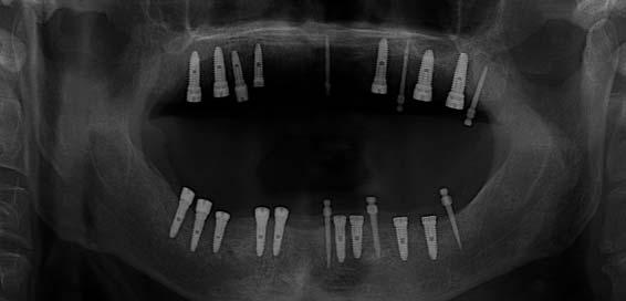 초진시파노라마사진으로서좌측구치부에서 sinus inferior wall 까지의잔존골이 10mm 정도관찰되었다. Fig. 23.