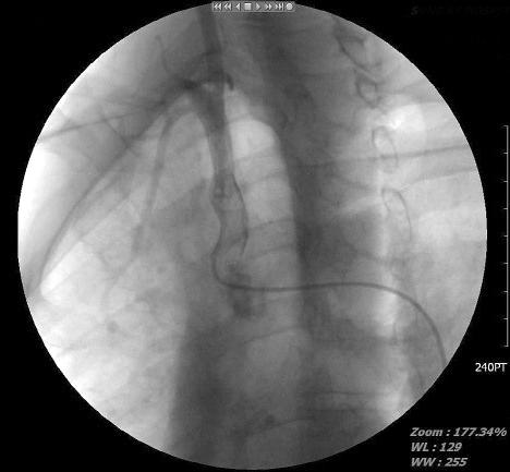 Preoperative angio computed tomography shows the discontinuous subclavian artery under the fracture site. 군과함께흉곽출구증후군의한원인이다 3).