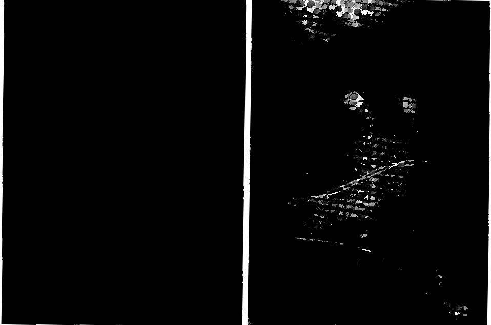 저 자 : 신선희 김주완 이영아 윤혜선 이홍진 이경자 Fig.2.Chestx-rays ofpatient8 demonstratea severe pneumothorax before (A)and after(b)placementofamodifiedpigtailcatheter. Table1.