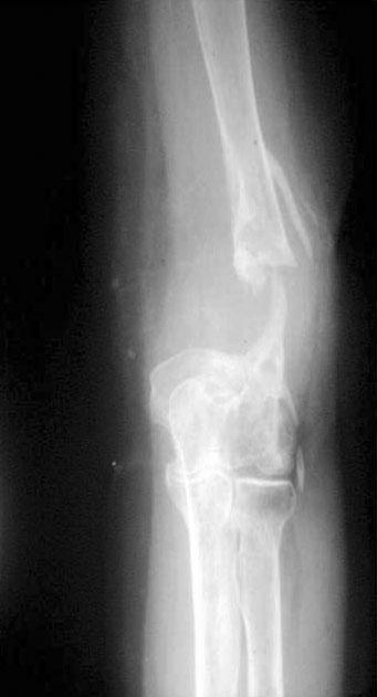 (A) Preoperative radiograph shows nonunion with 5 cm bone defect of