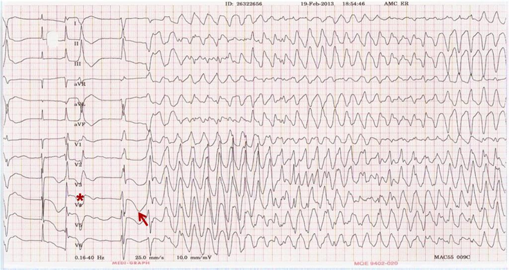 Cardiac Arrhythmias in the Intensive Care Units Nam GB Figure 3. Polymorphic ventricular tachycardia with QT prolongation in a patient hospitalized for subarachnoid hemorrhage.