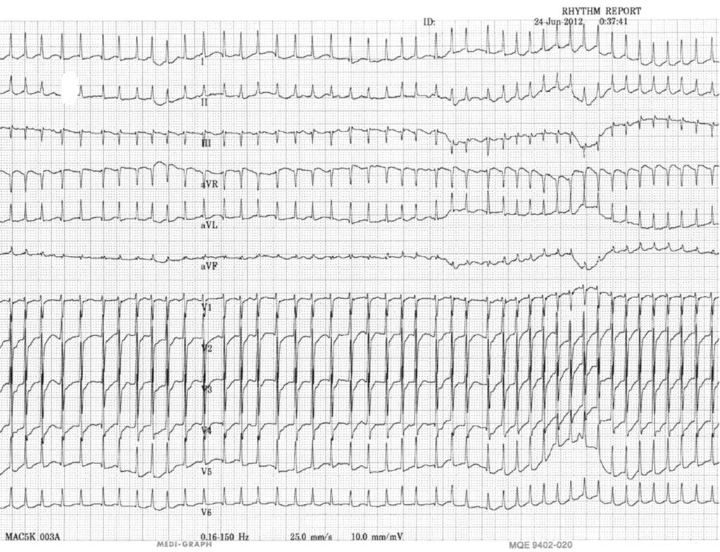 Cardiac Arrhythmias in the Intensive Care Units Nam GB Figure 4. A narrow QRS tachycardia in a 78 year-old male patient with biliary sepsis.