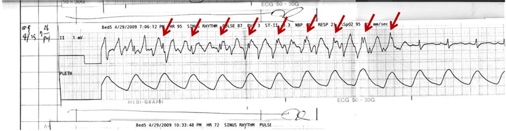 J Neurocrit Care 2014;7(1):25-32 Figure 5. Monomorphic ventricular tachycardia in a patient with structurally normal heart.
