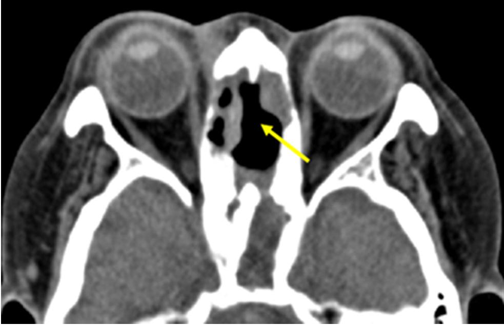 (C, D) The coronal and axial views of contrast computed tomography show chronic inflammatory changes in form of the destruction of the nasal septum and ethmoid sinus (yellow arrow).