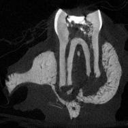4. 흰쥐구치치수괴사치근단치주염모델의 CT image 와동형성후 4 주차에쥐상악어금니 micro CT 촬영결과치근단부위에 방사선투과상이증가하였고, 주위치조골의골소주의불규칙적인소실이 관찰되었다. (Fig. 5) Fig. 5. 건전한치아 ( 上 ) 와와동형성 4 주차치아 ( 下 ) 처치한총 28개의치아중치수강저가천공된 6개의치아는치근단병소크기측정에서제외하였다.