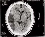 지역사회중심재활교육 뇌경색환자의뇌전산화단층촬영 (CT) 사진 뇌출혈환자의뇌전산화단층촬영 (CT) 사진 6.