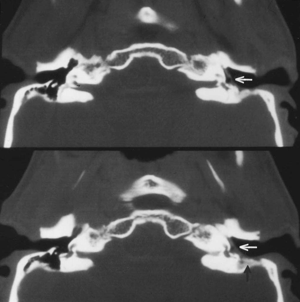 강명구 외 Fig. 2. Schematic figures of operating technique. A Surgical view. B Axial view. While preserving the posterior wall, the EAC was widened up to the facial nerve canal (arrows).