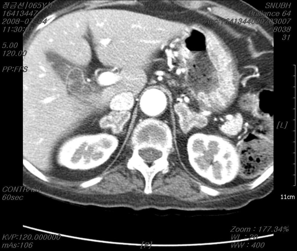 증례로본당뇨병의진단과치료 O/S Adrenal CT Bilateral adrenal hyperplasia