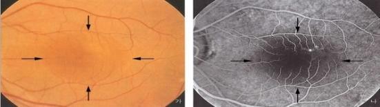 당뇨병성황반부종 최종목표예방치료 AMD(Age-related