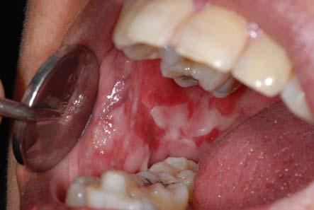 구강편평태선환자에서발생한암종의증례보고및문헌고찰 Fig. 1. Clinical presentation of the lesion with oral lichen planus 08.12.03 Whole body scan mlignancy of Lt.