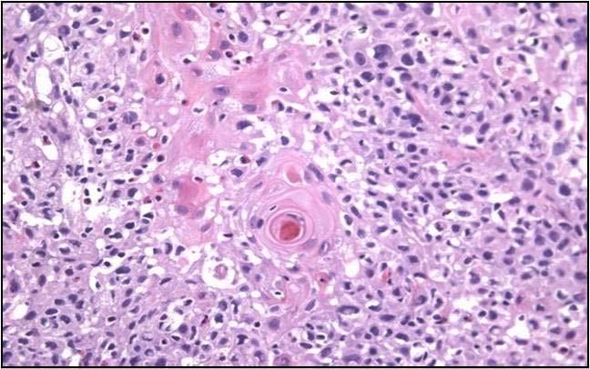 microscopic examination. H & E (x 400) Keratin pearl with squamous tumor cells Ⅲ.