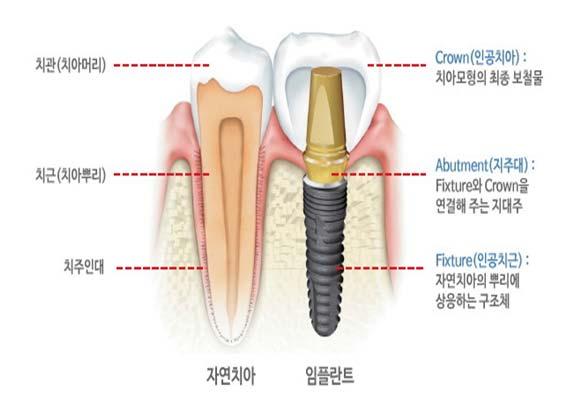 치과용임플란트란, 치아가결손된부위에주변치아를손상하지않고특수금속으로만든인공치근을치조골에이식하여본래의자기치아와같은기능을수행하는이식체로정의된다. 치과용임플란트는치조골에이식되는고정체 (Fixture), 지대주 (Abutment) 및치아의형상을재현시켜주는크라운 (Crown) 으로구성되어있으며, 통상적으로고정체와지대주를임플란트라고한다.