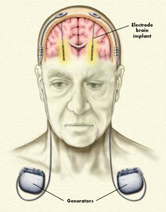 동사시스템의적용분야는뇌수술방법중 DBS(Deep Brain Stimulation) 즉, 뇌심부자극술에해당한다. DBS 란비정상적으로작동하는뇌의특정부위에전극을삽입하고, 전기자극을주어비정상적으로작동하는신경회로를조절함으로써증상을호전시키는치료방법이다. 수술후환자는뇌속에전극과쇄골아래배터리가삽입되어, 약용량을조절하듯이증상에따라전기자극의강도를조절한다.