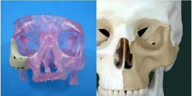 그림 옥스퍼드퍼포먼스머티리얼스의환자맞춤형인공뼈 3D 프린팅치과용교정기와보청기 미국얼라인테크놀러지는 3D프린터로제작하는환자맞춤형투명교정기인인비살라인