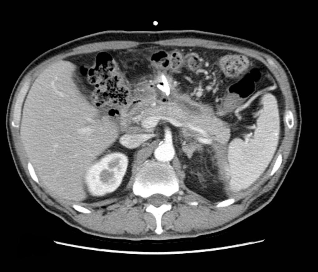 4초(85%), A B C D Figure 1. (A and B) Abdominal computed tomography (CT) showed a huge collection of gas and fluid distorting the pancreatic parenchyma.