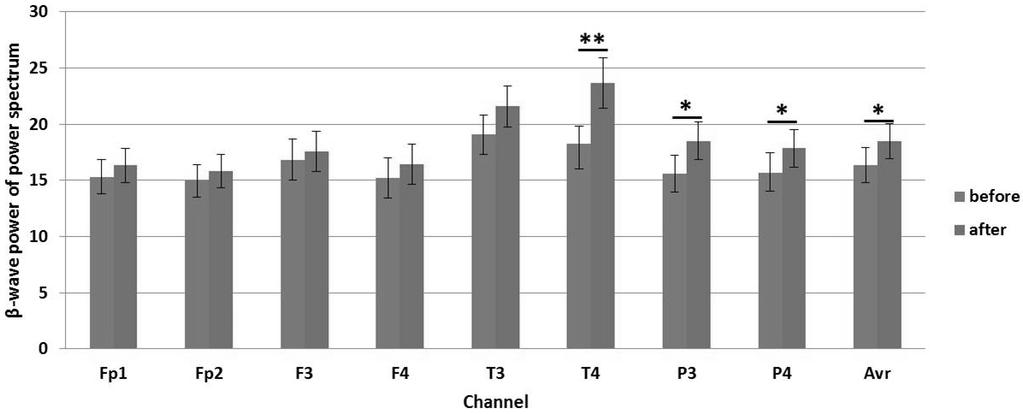 百會 (GV20) 顖會 (GV22) 자침이뇌파에미치는영향 Figure 5. Average value changes of Beta-power at the treatment group. power of QEEG(*p< 0.05, **p<0.01). Figure 6.