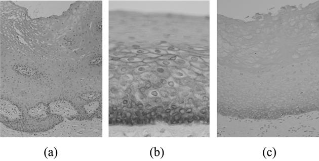 Expression of TGF-β1 and EGFR in Irritation Fibroma and Oral Leukoplakia 5BCMF Expression of TGF-β1 Epithelium (%) Connective tissue(%) Normal Oral Mucosa Irritation Fibroma Oral leukoplakia No stain