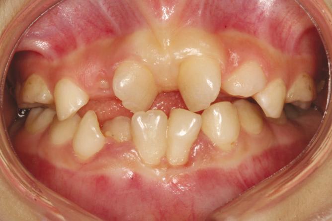 Oral and dental anomalies of CdLS including dental caries, dental erosion, microdontia, crowding, rotation of incisors, scissors-bite of left posterior teeth and bifid uvula. Ⅲ.
