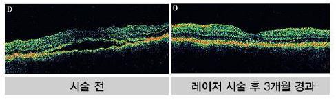 망막질환치료에대한기존레이저치료와루트로닉의치료 (R:GEN) 결과비교 [ 그림