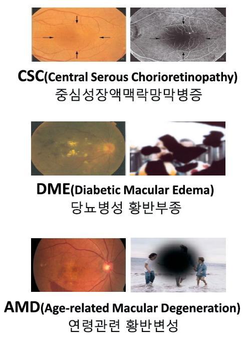 in Ophthalmology, 루트로닉 [ 그림 10] 망막질환 (