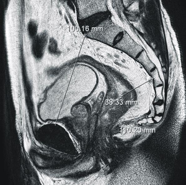 MRI 상에서 골반의 중시상면에서 골반의 전후 직경(obstetric conjugate, 천골 융기(sacral promontory)부터 치골 결합(symphysis pubis)의 상연까 지의 거리)과 천골 길이(천골 융기부터 미골의 최단 직 5) 종양의 T 병기 종양의 T 병기는 병리 조직 검사를 통하여