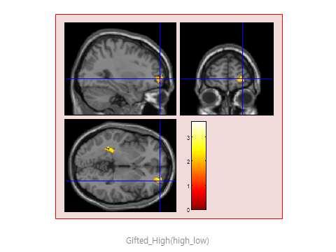 [ 그림 13] 영재그룹의 fmri 과제 ( 복잡 ) 수행시활성화된뇌영역 [ 표 10] 영재그룹의 fmri과제