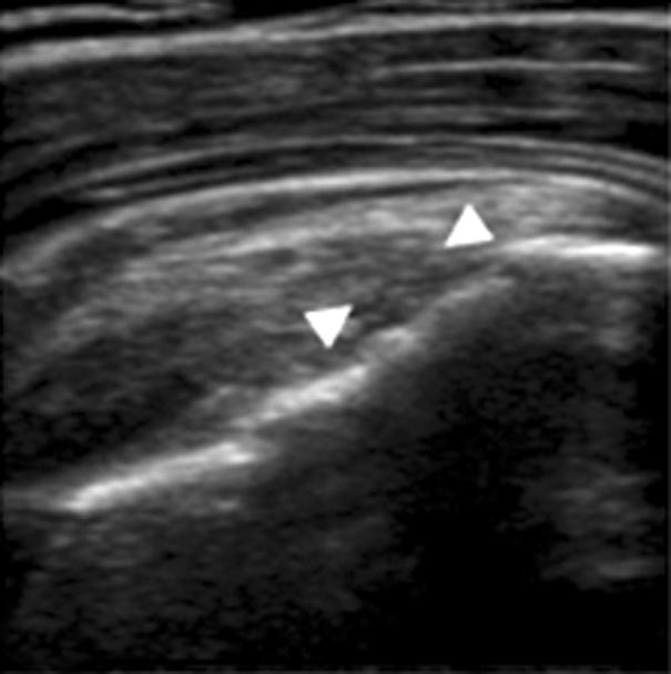 부터 Fig. 1. Abnormal ultrasonographic finding of hemiplegic shoulders.