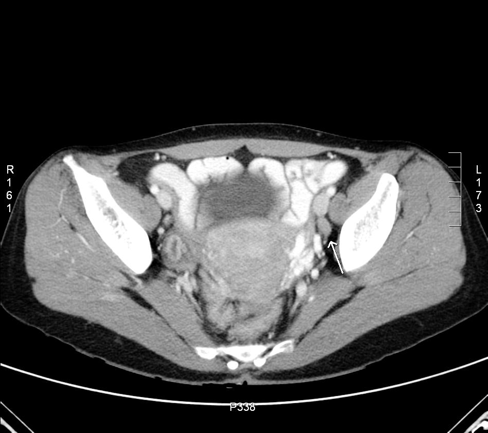 박영외 6 인. 자궁목의육종양편평세포암 1 예 Fig. 1. Pelvis CT showed the LN enlargement at Lt. iliac area (arrow) and ill-defined cervical mass.