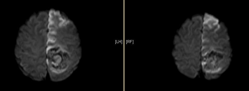 2) : Acute infarction, Left ACA territory with hemorrhages, Left parietal lobe Fig. 1. CT images demonstrate hemorrhages within the left ACA territory infarction. Ⅱ. 증례 1. 환자 : 김 (F/55) 2.