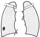 대략적기준 소견의미와대책소견의미와대책 투과성증강 X 선사진의폐야가거무스름하게되어있는것으로, 폐의공기함량이증대해있다.