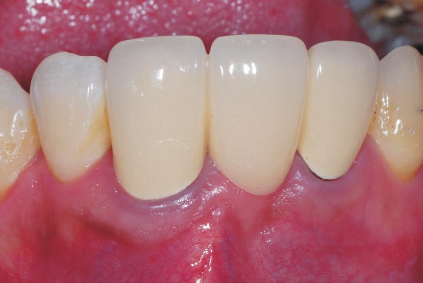 It was planned to conduct implant placement immediately after tooth extraction.