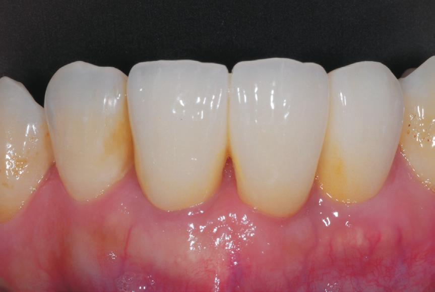 (C) Implant placed immediately after tooth extraction. Placed with non-submerged technique.